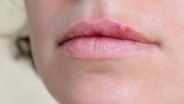 Herpesbläschen an einem Mund © Fotolia.com Foto: Ekaterina