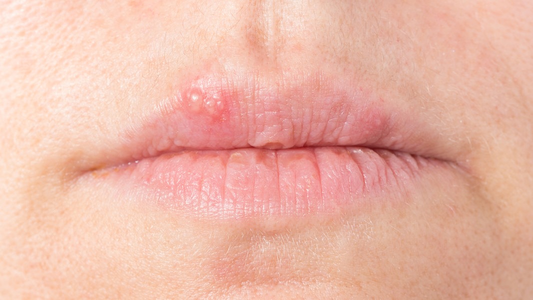 Herpes An Lippen Oder Nase Richtig Behandeln Ndr De Ratgeber Gesundheit