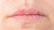 Herpes der Lippe © fotolia Foto: bmf-foto.de