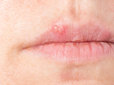 Herpes An Lippen Oder Nase Richtig Behandeln Ndr De Ratgeber Gesundheit