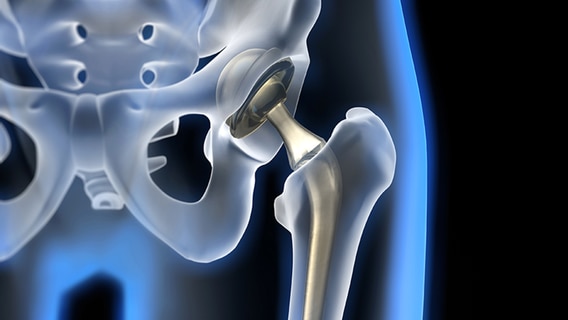 Graphical representation of an artificial hip joint.  © fotolia.com Photo: psdesign1