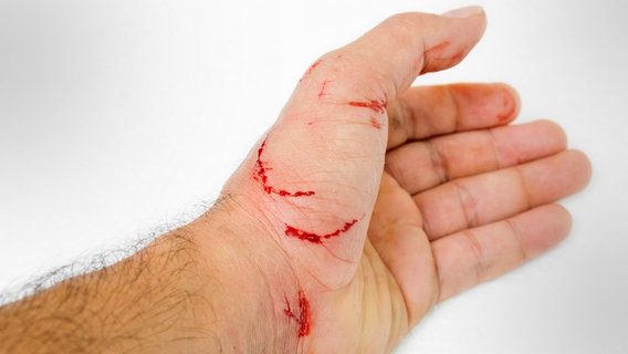 Eine Hand mit einer Katzenbissverletzung © Fotolia.com Foto: mydegage