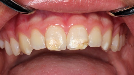 Blick in einen Mund mit Kreidezähnen. © picture alliance dpa Foto: Prof. Dr. Norbert Krämer