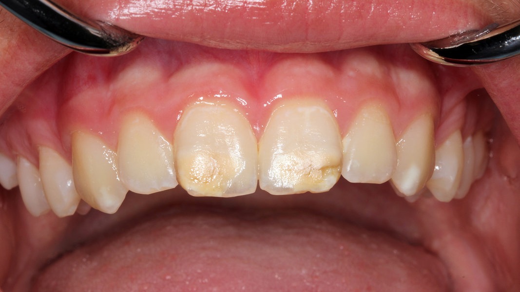 Zähne mit 20 schlechte Schlechte Zähne