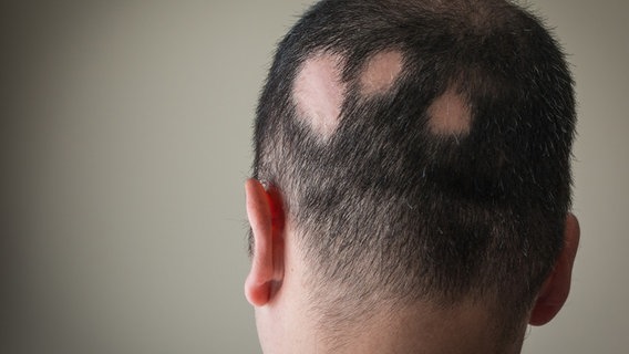 Frau mit kreisrundem Haarausfall. © fotolia Foto: Alex Papp