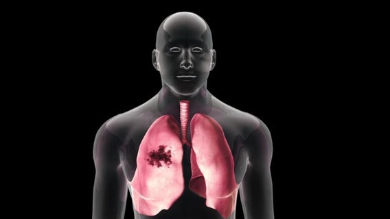 Unterversorgtes Gewebe in der Lunge (dunkel), grafisch dargestellt. © NDR 