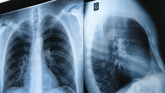 Röntgenaufnahme einer Lunge © colourbox Foto: Bunyos