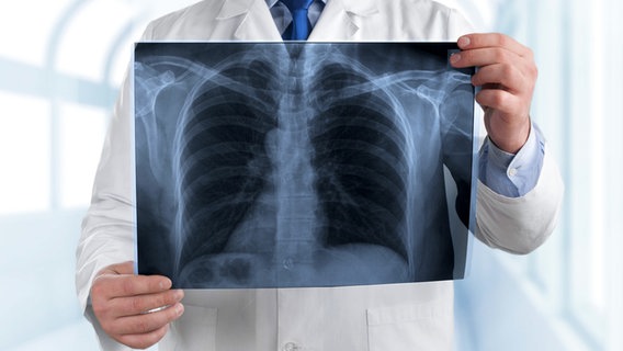 Arzt hält eine Rötgenaufnahme einer Lunge. © fotolia Foto: BillionPhotos.com