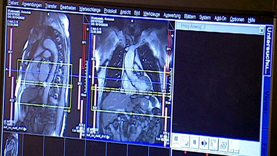 MRT-Bilder eines Herzens © NDR 