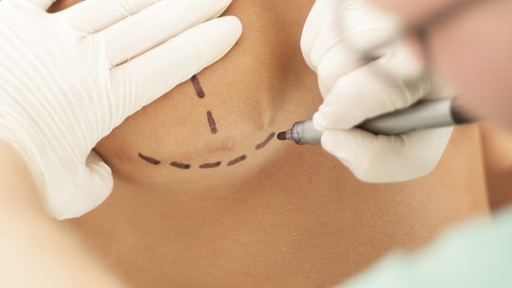 Ein Arzt skizziert die Schnitte für eine OP auf der Haut einer Frau. © fotolia.com Foto: Peter Atkins