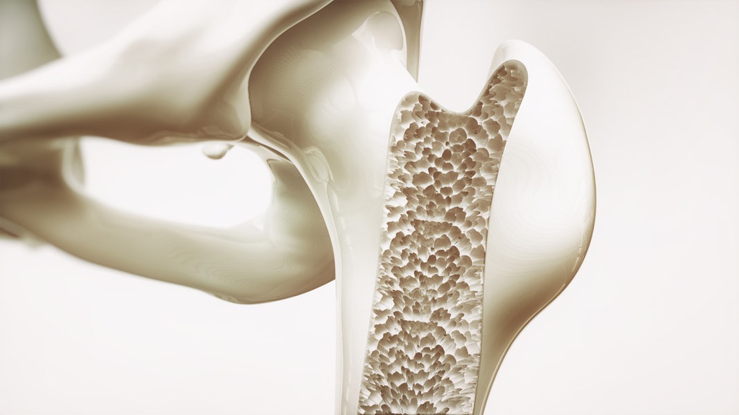 Osteoporosis: recognizing symptoms, initiating the right therapy |  > – Guide