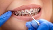 Zähne mit Zahnspange © fotolia Foto: milanmarkovic78