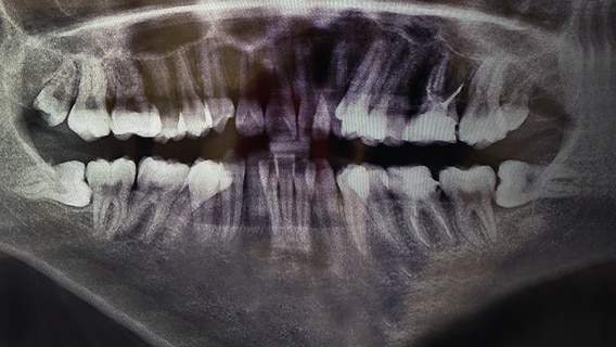 Das Röntgenbild eines Kiefers. © NDR 