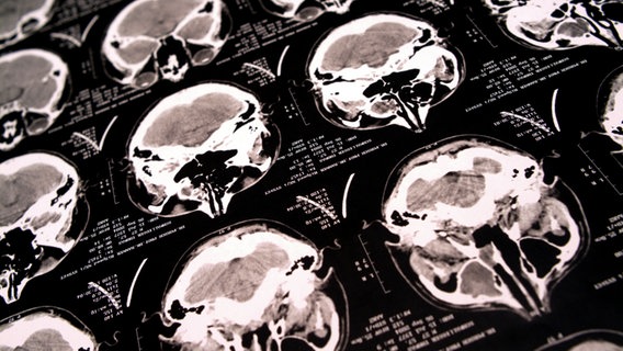 Röntgenbild einer Computertomographie des Gehirnschädels © picture alliance / Bildagentur-online 