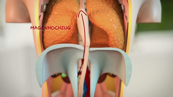 Schematische Darstellung: Magenhochzug bei der operativen Entfernung der Speiseröhre wegen Krebs. © Screenshot 