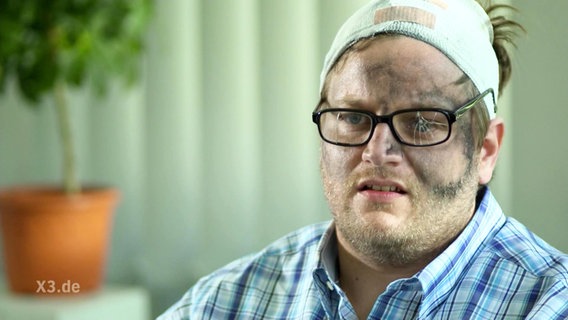 Ein Mann mit Kopfverband, verbrannter Haut und kaputter Brille.  