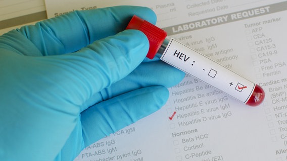 Ein Blutröhrchen vor einem Formular mit der Aufschrift HEV © fotolia.com Foto:  jarun011