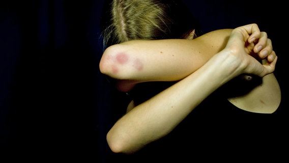 Junge Frau verschränkt ihre Arme vorm Gesicht. An den Ellenbogen sind blaue Flecke. © Nanduu/Photocase Foto: -