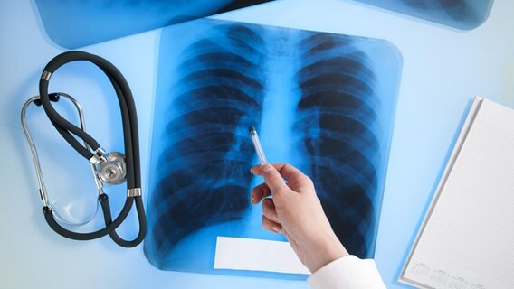 Eine Ärztin zeigt mit einem Kugelschreiber auf eine Röntgenaufnahme einer Lunge © Colourbox Foto: Vladimir G.