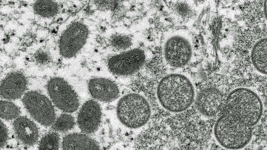 Monkeypox en Allemagne : à quel point le virus est-il dangereux ?  |  NDR.de – Guide
