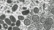 Eine elektronenmikroskopische Aufnahme aus dem Jahr 2003, die von den Centers for Disease Control and Prevention zur Verfügung gestellt wurde, zeigt reife, ovale Affenpockenviren (l) und kugelförmige unreife Virionen. © CDC/AP/picture-alliance Foto: Russell Regner