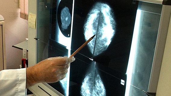 Auswertung von Mammografieaufnahmen © dpa/piture-alliance Foto: Wolfgang Thieme