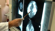Auswertung von Mammografieaufnahmen © dpa/piture-alliance Foto: Wolfgang Thieme