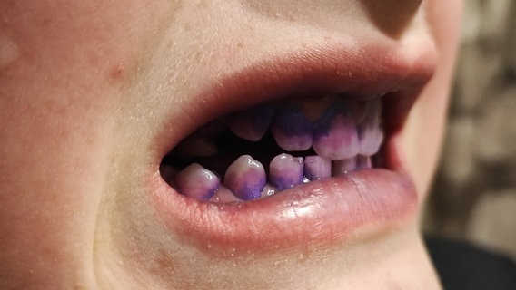 Zähne in einem Kndermund sind mit einer speziellen Farbe gefärbt Zähne in einem Kndermund sind mit einer speziellen Farbe gefärbt © Unimedizin Greifswald