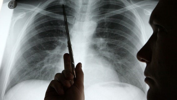 Ein Arzt zeigt auf eine Stelle eines Röntgenbildes eines Patienten, bei dem Lungenkrebs diagnostiziert wird. © picture alliance/dpa Foto: Rainer Jensen