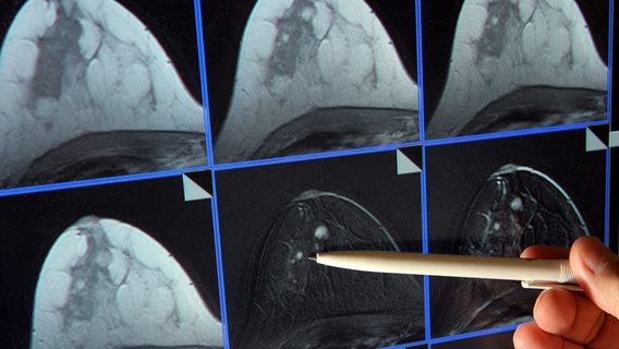 Auf der Bildschirmdarstellung einer Magnetresonanz-(MR)-Mammographie ist ein  Tumor in der Brust einer Patientin zu sehen. © dpa-Zentralbild/dpa Foto: Jan-Peter Kasper