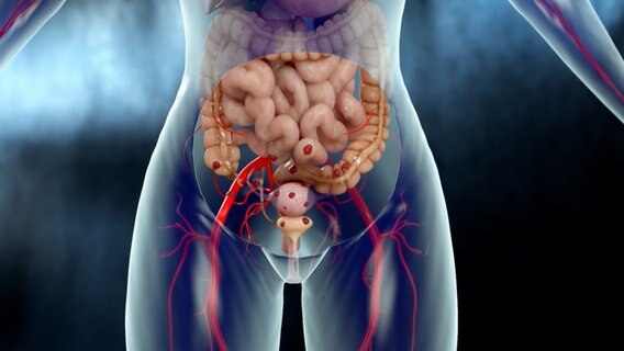 Eine Grafik zeigt Endometriose im Inneren des Körpers. © NDR 
