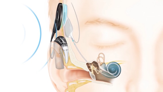 Eine Illustration zeigt das Prinzip eines Gehörimplantats. © © Cochlear Limited 2022. Alle Rechte vorbehalten 