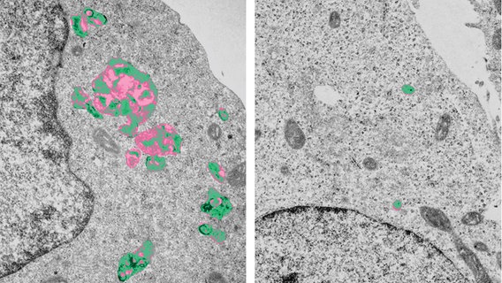Lysosomen (pseudokoloriert) in der Elektronenmikroskopie. Zellen, denen LYSET fehlt (linkes Bild), haben vergrößerte Lysosomen mit unverdautem Speichermaterial. © Dr. Michaela Schweizer 