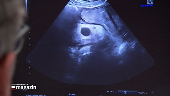 Auf einem Ultraschallbild wird ein Eierstock untersucht. © NDR Foto: NDR Screenshot