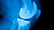 Ein Röntgenbild zeigt einen Gelenkersatz © Colourbox Foto: Edward Olive