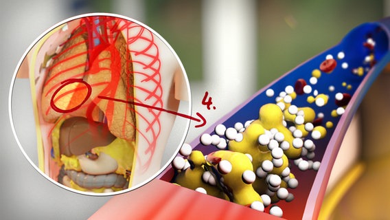 Schematische Darstellung des Blutkreislaufs und der Fettablerungen in den Adern. © NDR 