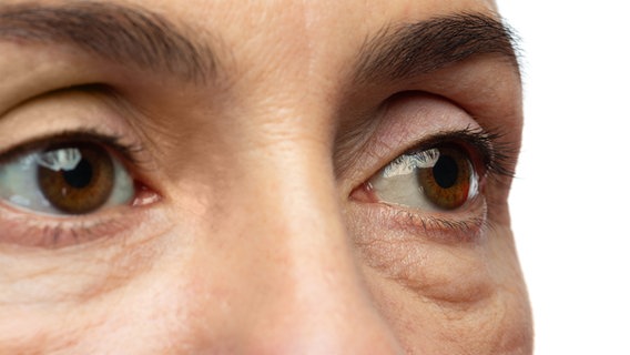 Die Augen einer Frau mit Tränensäcken darunter. © Colourbox Foto: Blackday