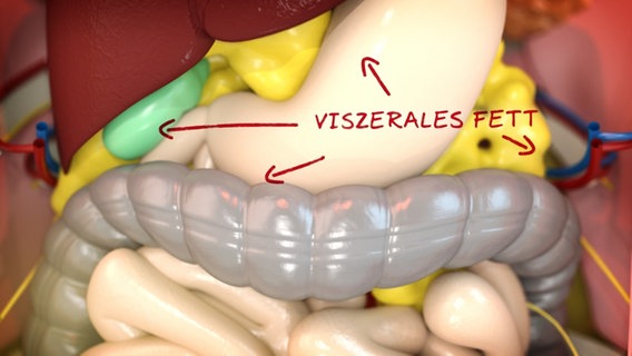 Schematische Darstellung: Viszerales Fett hat sich ausgedehnt. © NDR 