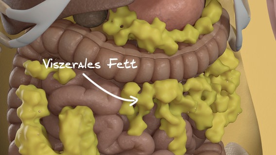 Schematische Darstellung: gelbe Fettpolster breiten sich im Bauchraum aus. © NDR 