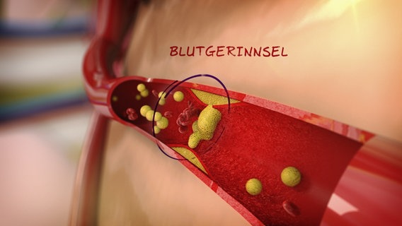 Schematisch Darstellung: Gelbe Teilchen verstopfen das Blutgefäß. © NDR 