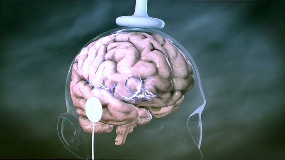Gehirn bekommt Elektroschock  