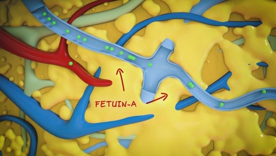 Schmatische Darstellung: Lebergewebe mit Fetteinlagerungen, das Fetuin-a ausschüttet. © NDR 