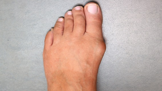 Weiblicher Fuß mit Ballenzeh (Hallux Valgus) steht auf grauem Boden © imago images/CHROMORANGE 