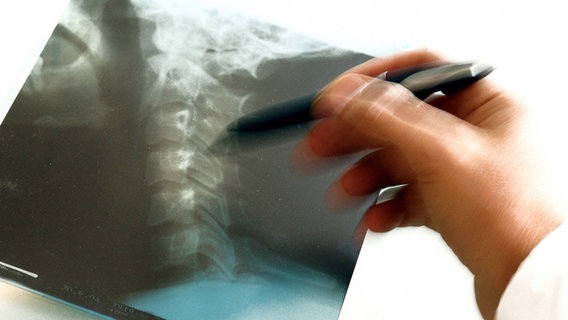 Ein Arzt zeigt mit einem Stift auf das Röntgenbild einer Halswirbelsäule. © picture alliance / blickwinkel/McPHOTO | McPHOTO Foto: blickwinkel/McPHOTO