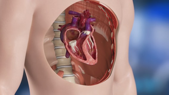 Schematische Darstellung: geöffneter Torso mit Herz. © NDR 