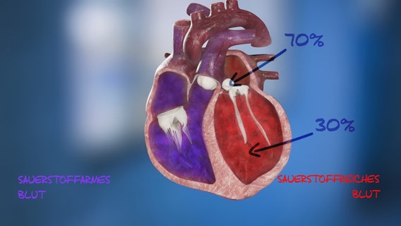 Schematische Darstellung: Herz mit Beschriftung "70 %" am Pfeil  auf den Vorhof, "30 %" am Pfeil auf die linke Herzkammer. © NDR 