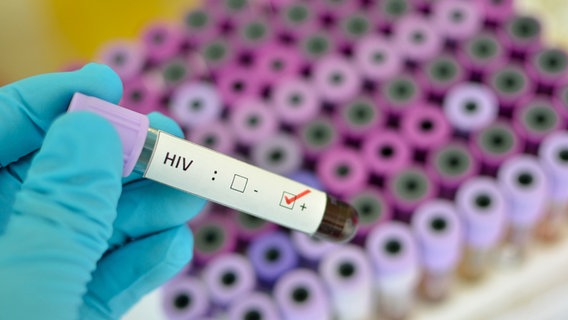 Blutprobe mit der Aufschrift HIV-positiv © fotolia Foto: jarun011