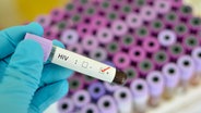 Blutprobe mit der Aufschrift HIV-positiv © fotolia Foto: jarun011