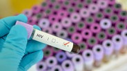 Blutprobe mit der Aufschrift HIV-positiv © fotolia Foto: jarun011