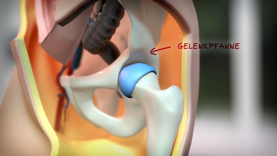 Schematische Darstellung: linke Hüfte mit Beckenknochen und Oberschenkelknochen. © NDR 